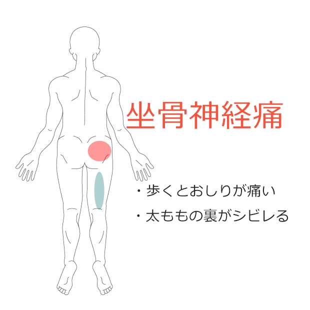 歩く と おしり が 痛い