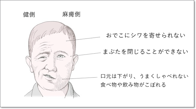 神経痛 顔面 顔面けいれんと三叉神経痛の解説です