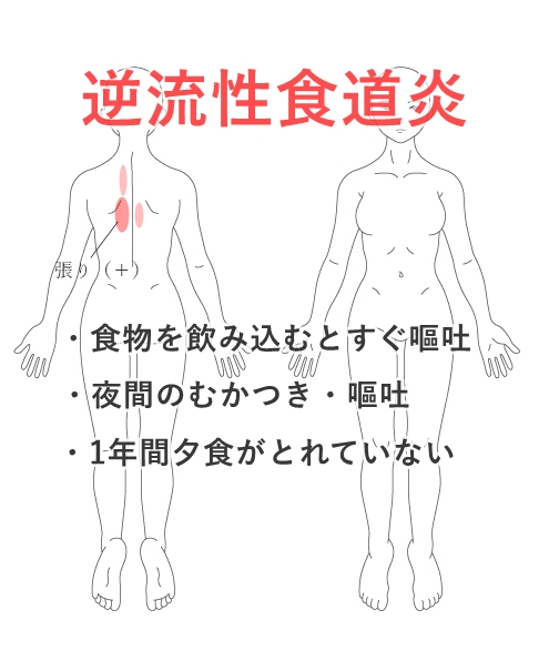 性 の 痛み 背中 炎 食道 症状 逆流 逆流性食道炎、悪化するとどうなるの？｜府中オステオパシーまるちゃん整体院