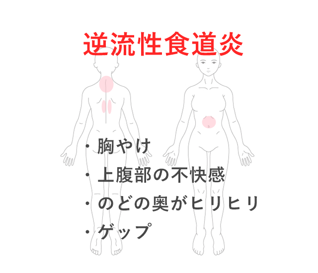 逆流 性 食道 炎 症状 背中 の 痛み